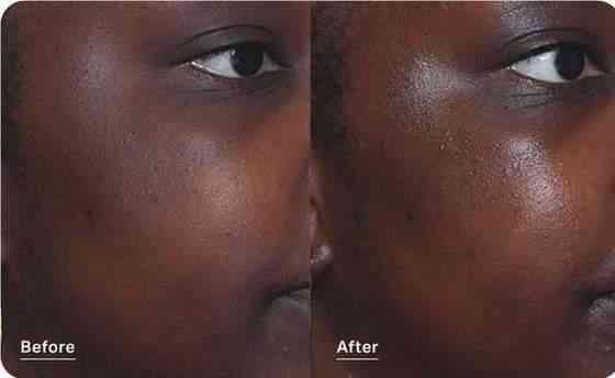 Hydrafacial before and after photo showing improved hydration and glow