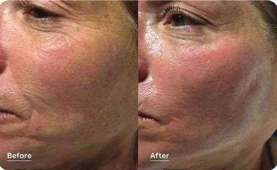 Hydrafacial before and after photo showing smoother, plumper skin around fine lines