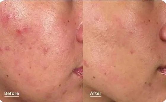 Hydrafacial before and after photo showing clearer, less congested skin after a series of clarifying treatments